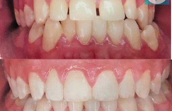 ¿Conoces todos los beneficios del hilo dental?